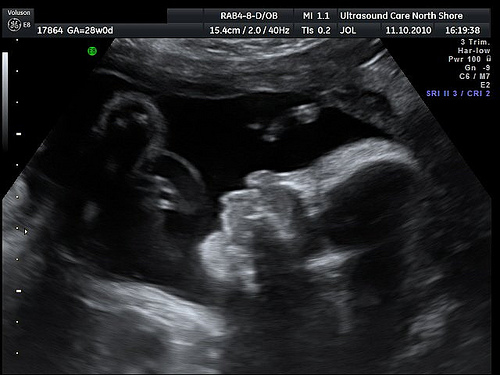 Ultrasound Baby