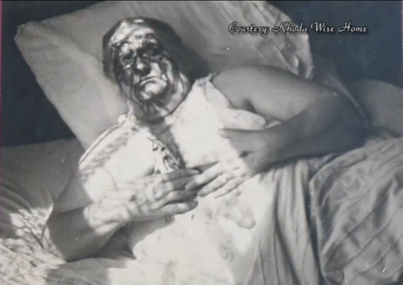 Rhoda Wise stigmata